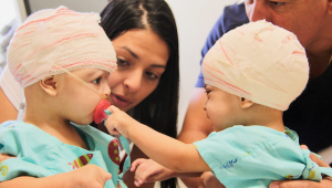 As gêmeas Lis e Mel nasceram ligadas pelo crânio