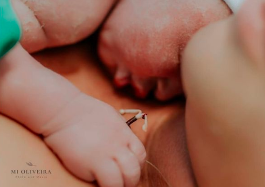 Bebê nasce segurando DIU no Rio de Janeiro
