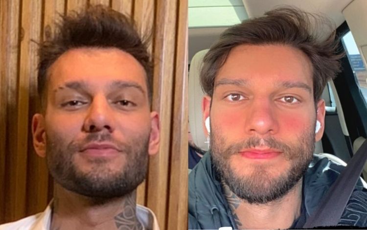 Lucas Lucco antes e depois da reversão da harmonização facial