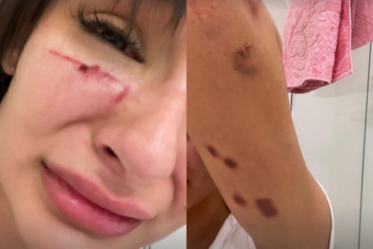 montagem de fotos de mulher agredida