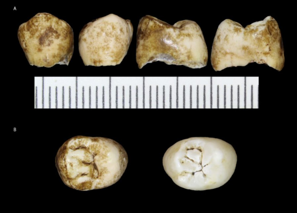 Dentes pertencentes a uma criança que morreu há 2.500 anos atrás