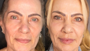 Comparação antes e depois da harmonização facial