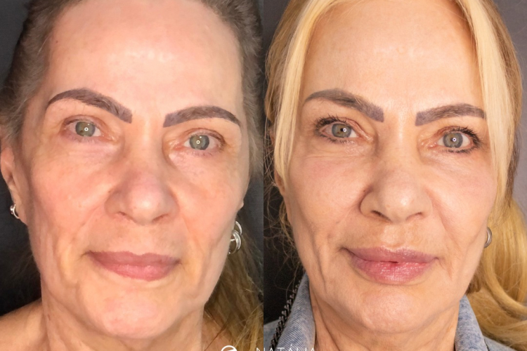 Comparação antes e depois da harmonização facial