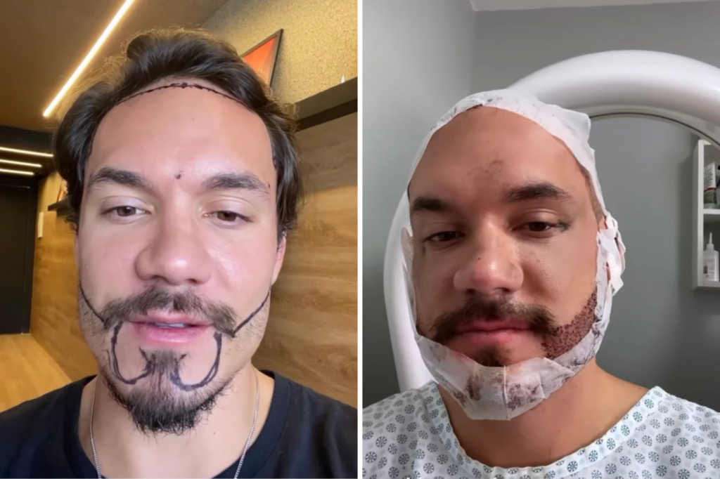 Ex BBB Eliezer realiza transplante de cabelo e barba para