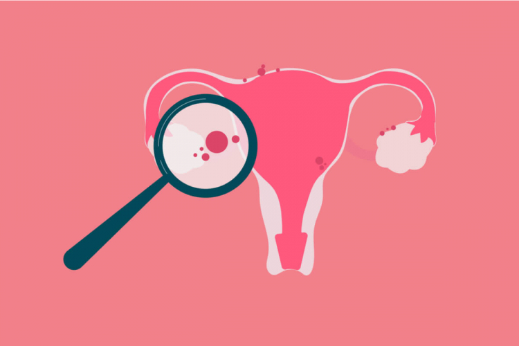 Endometriose: conheça as causas, os sintomas e os tratamentos