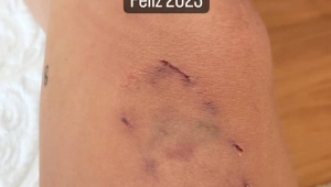 Hematoma na perna de Anitta
