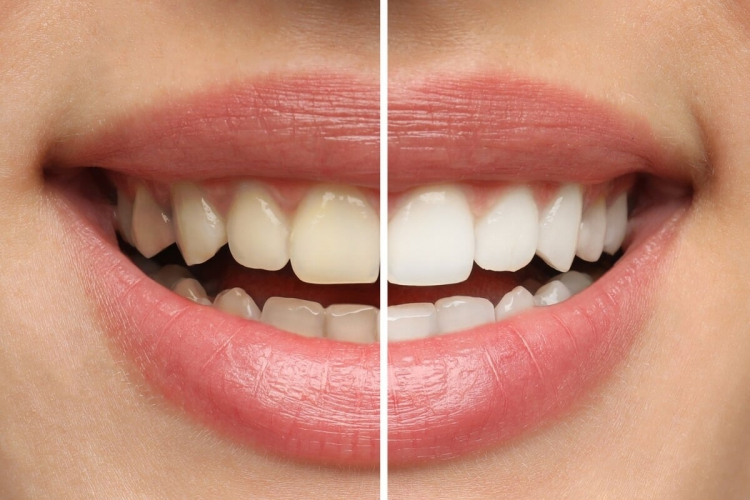 3 riscos do clareamento dental caseiro para a saúde da boca