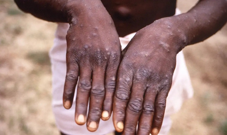 Argentina coloca navio que saiu do Brasil em quarentena após sintomas de mpox na tripulação