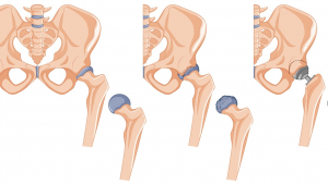 Quadril tratamento