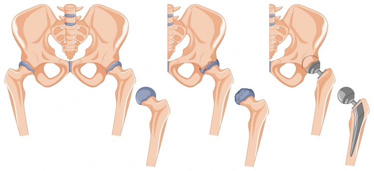 A evolução das próteses de quadril e a durabilidade dos implantes modernos