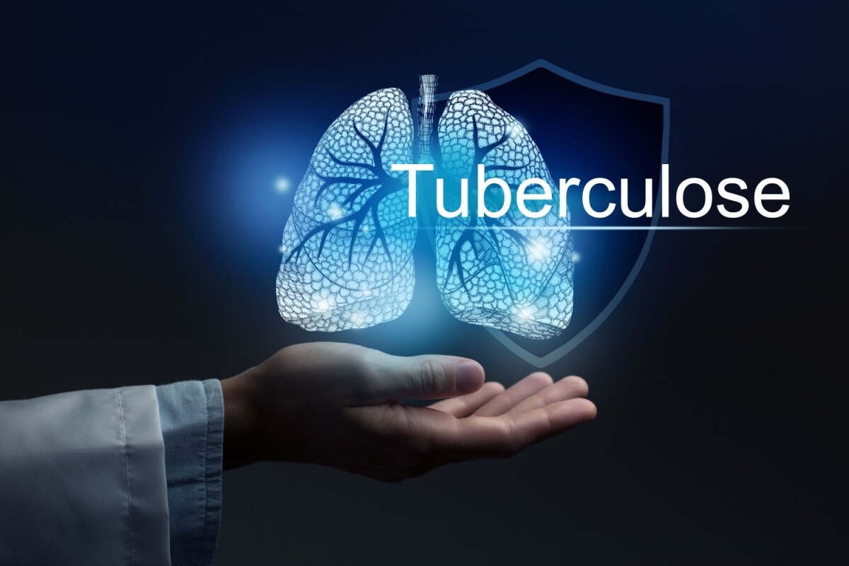 A tuberculose é uma doença infecciosa que afeta principalmente os pulmões 