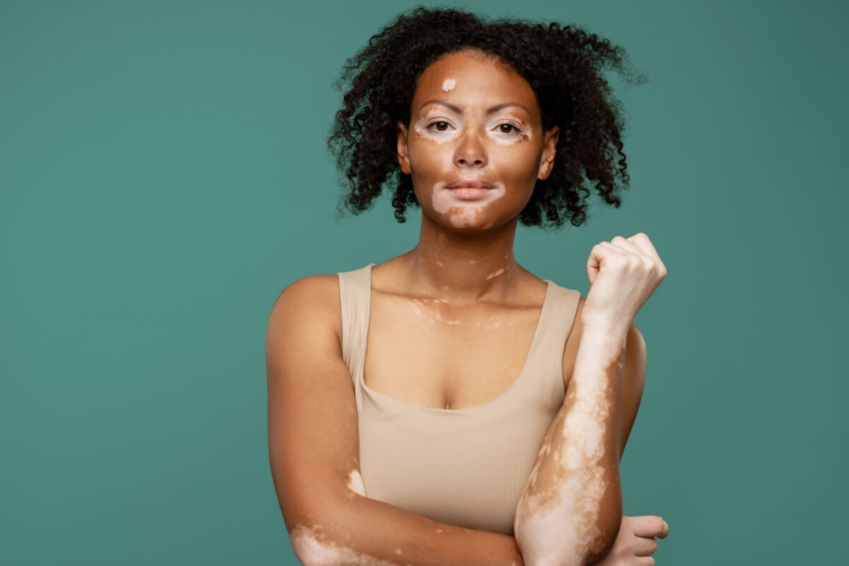 O vitiligo é uma doença autoimune que provoca a descoloração da pele 
