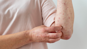 avatar Alergia cutânea no braço de uma pessoa