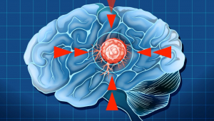 ilustracao tumor cerebro