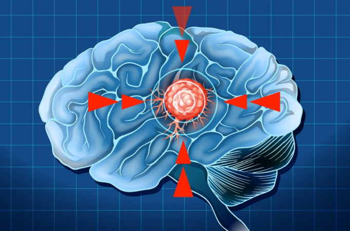 ilustracao tumor cerebro