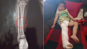 menino fratura tíbia em escola em peruibe