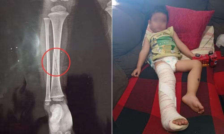 MPSP investiga fratura em criança durante briga em creche de Peruíbe