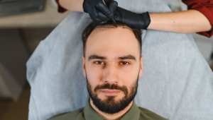 Transplante capilar: entenda quando pode ser necessário refazer o procedimento