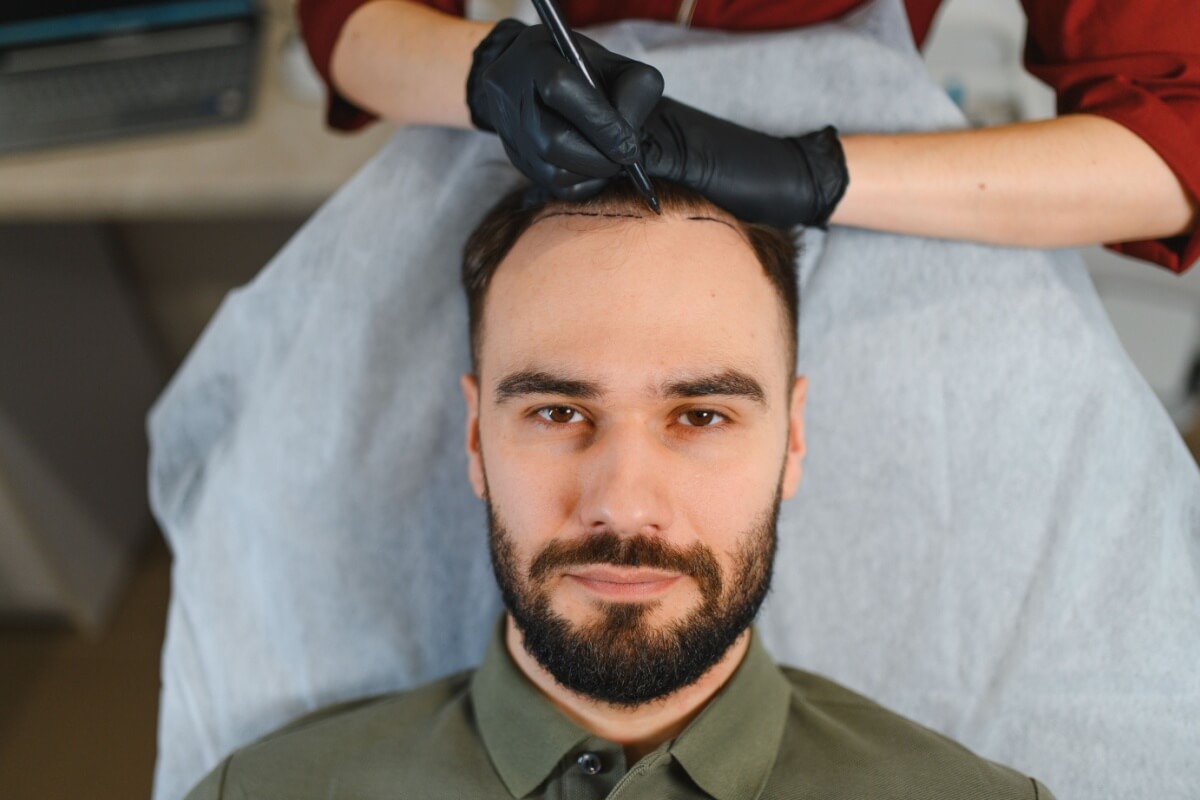 A recomendação de um novo transplante capilar varia conforme as especificidades do paciente 