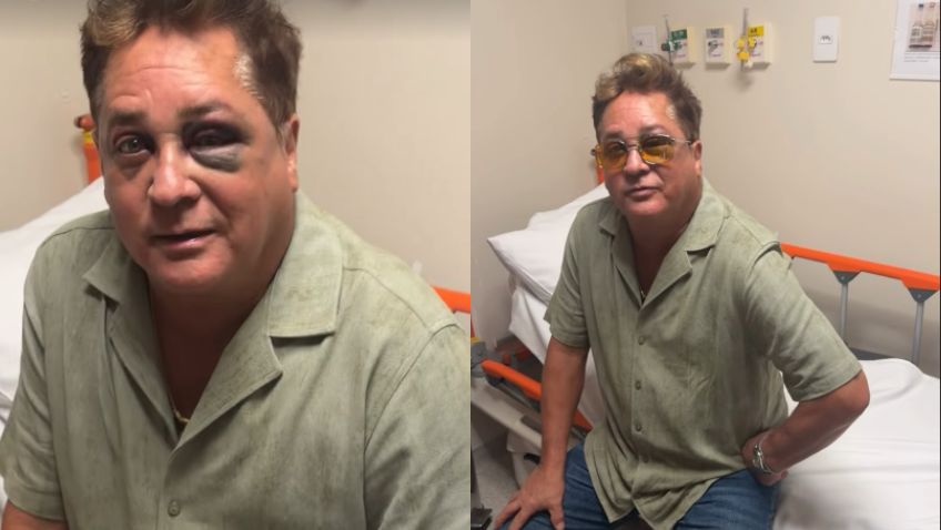 Cantor Leonardo sofre acidente e aparece com olho roxo