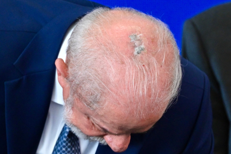President Lula (PT) reveals the scar from surgery to remove skin cancer carried out in April
