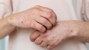 Sintomas e causas da dermatite atópica nos dias de frio